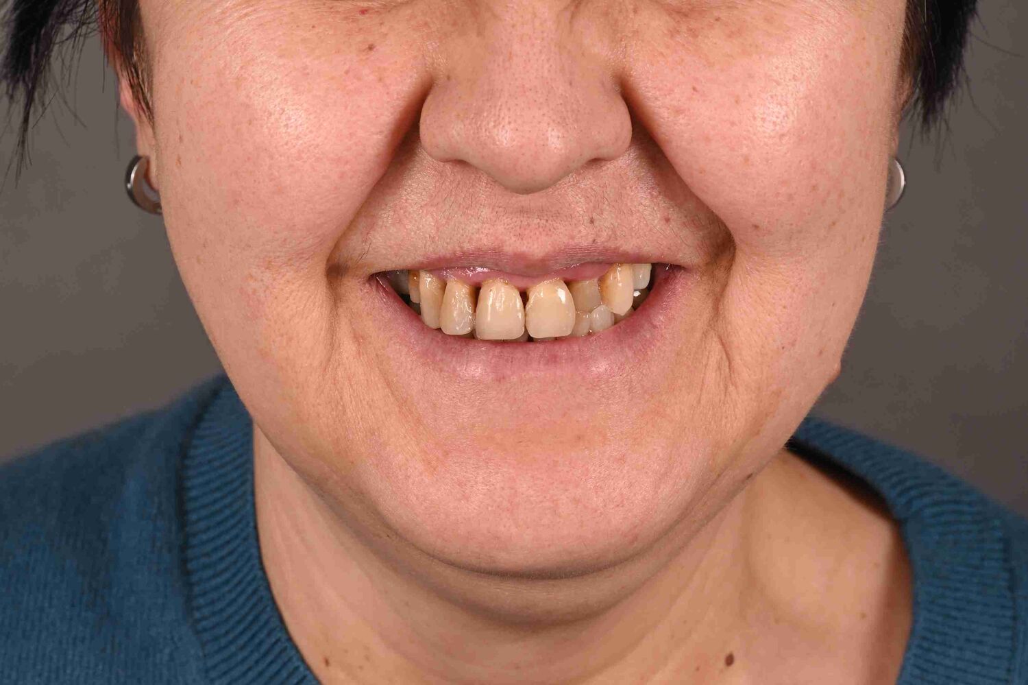 Pacient Clinica Dr. Alin Odor - Rezultat Implantologie